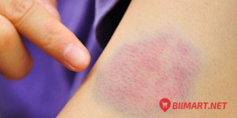 Cách Làm Tan Máu Bầm Hiệu Quả Bạn Cần Biết